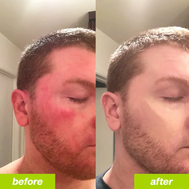 uvora_skin_before_after_1080_1